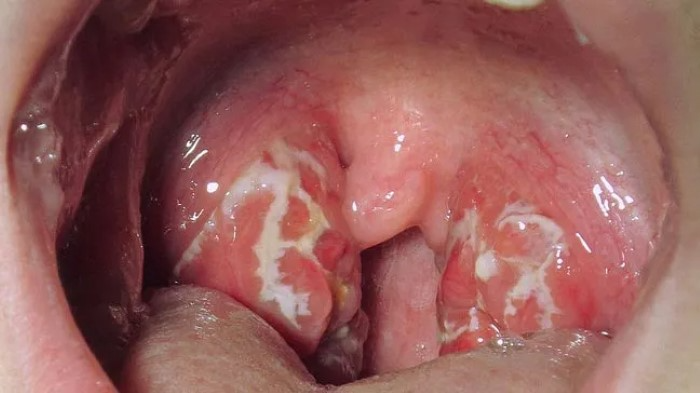 What Is Strep Throat 1