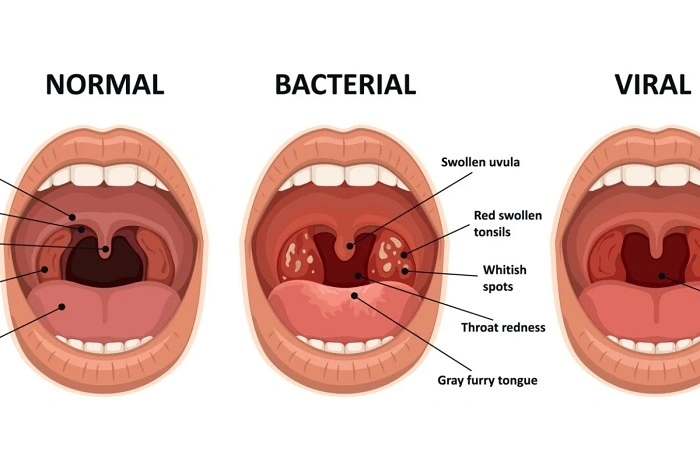 What Is Strep Throat