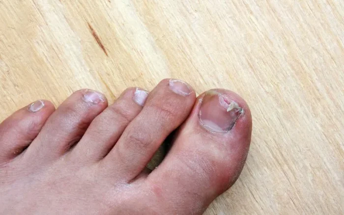 How to prevent your Toes from Cracking from Nail Polish e1756985413225